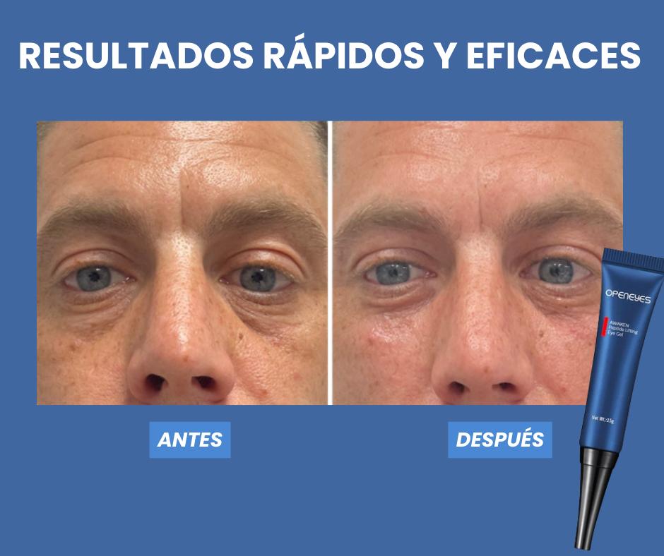 ELIMINA LAS OJERAS CON OPENEYES™  1+1 GRATIS